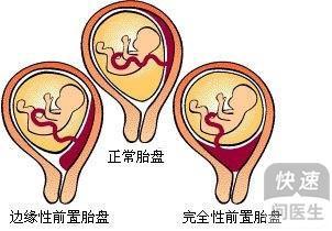 前置胎盘的主要临床症状是