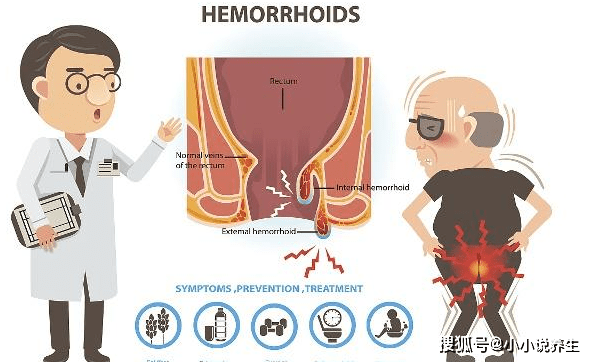 如何减轻痔疮症状