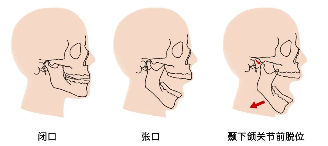 下巴脱臼三秒复位视频