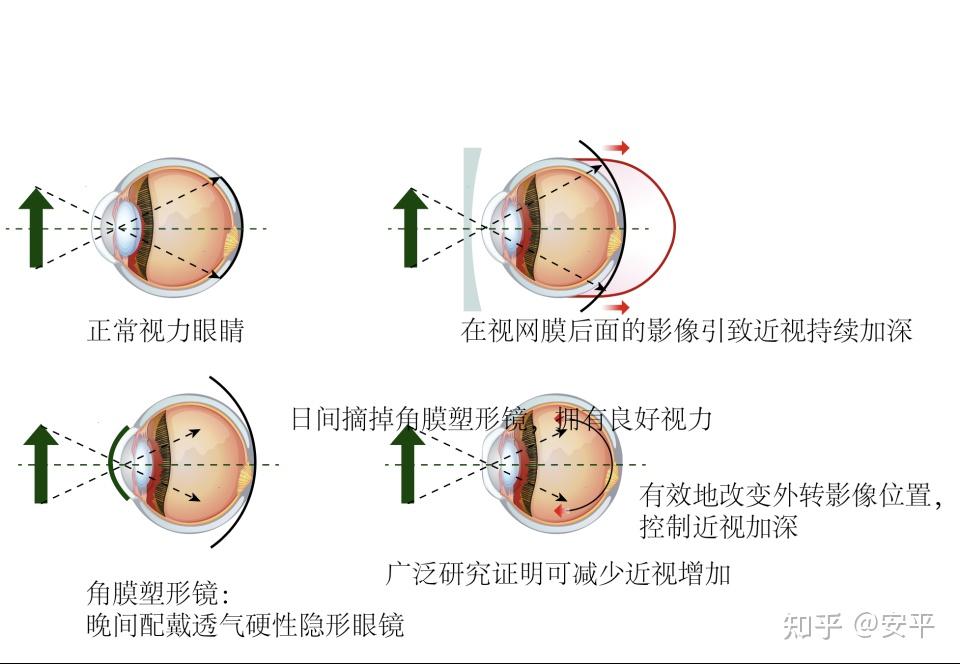 角膜塑形镜的利与弊多大可以戴